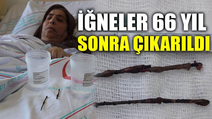 Vücudundaki iğneler 66 yıl sonra çıkarıldı