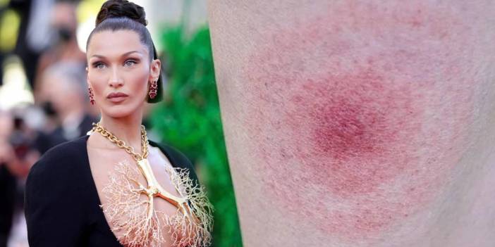 Lyme hastalığı nedir? Lyme hastalığının tedavisi var mı? Bella Hadid'in hastalığı Lyme'nin belirtileri nedir?