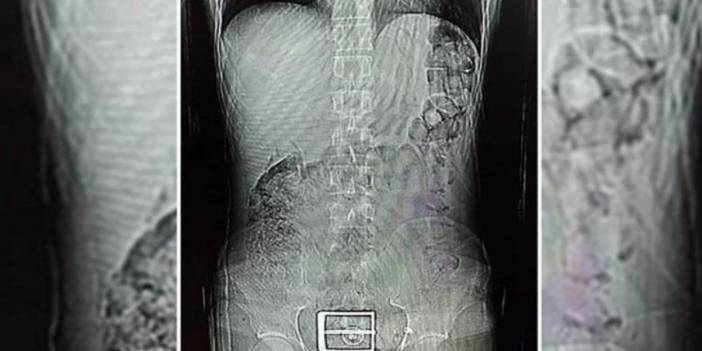 Röntgende Ortaya Çıktı! Mide Ve Bağırsağından Çıkanlar Şok Etti!
