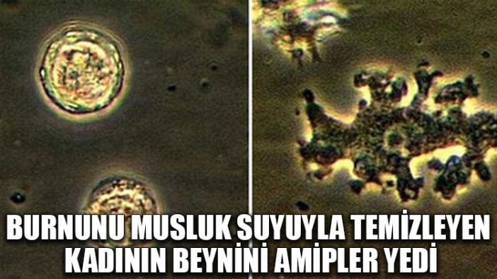 Burnunu musluk suyuyla temizleyen kadının beynini amipler yedi