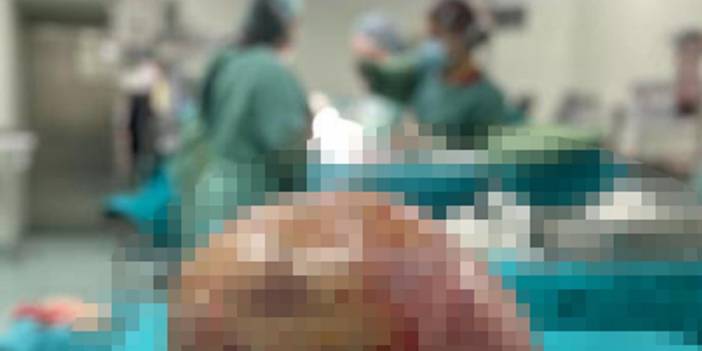 Karın Şişti, 20 Kilo Kitle Çıktı: Doktorlar Da İnanamadı!