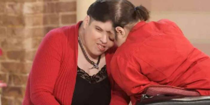 Doktorlar En Fazla 30 Yaşına Kadar Ömür Biçmişti: Dünyanın En Yaşlı Yapışık İkizleri 62 Yaşında Hayatlarını Kaybetti