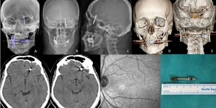 Bursa'da Diş Tedavisinde Kabus: Vida Hastanın Beynine Saplandı