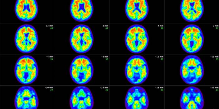 Alzheimer İlacı 'Donanemab' İçin Oy Kullanılacak