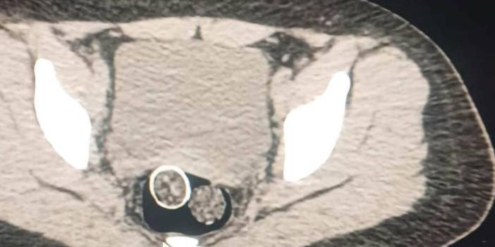 Uyuşturucular mide ve cinsel organından çıktı
