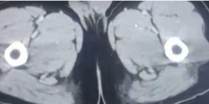 Midelerindeki uyuşturucuyla yakalandılar!