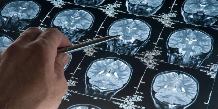 Alzheimer tarihe karışabilir! İşte yeni buluş