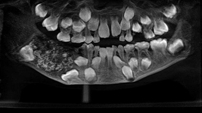 7 yaşındaki çocuğun ağzından 526 diş çıktı!