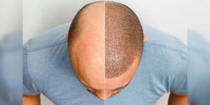 İstanbul'da turistlere saç ekimi yapan sahte doktor skandalı!