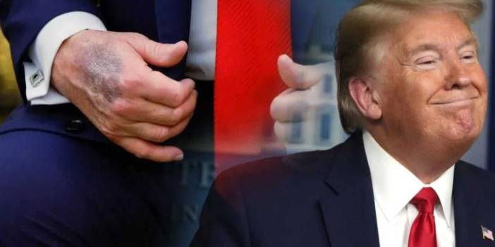 Trump elindeki morlukların nedenini açıkladı: Aşırı dozdan damarlarını patlatmış