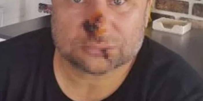 Yoğun bakımdan çıkan ünlü şarkıcı son durumunu açıkladı: Yüzü çürümeye başlamıştı!