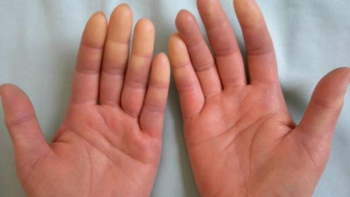 Soğuk havaların hastalığı: Raynaud fenomeni