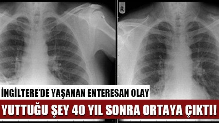 40 yıl ciğerlerinde oyuncak ile yaşadı!