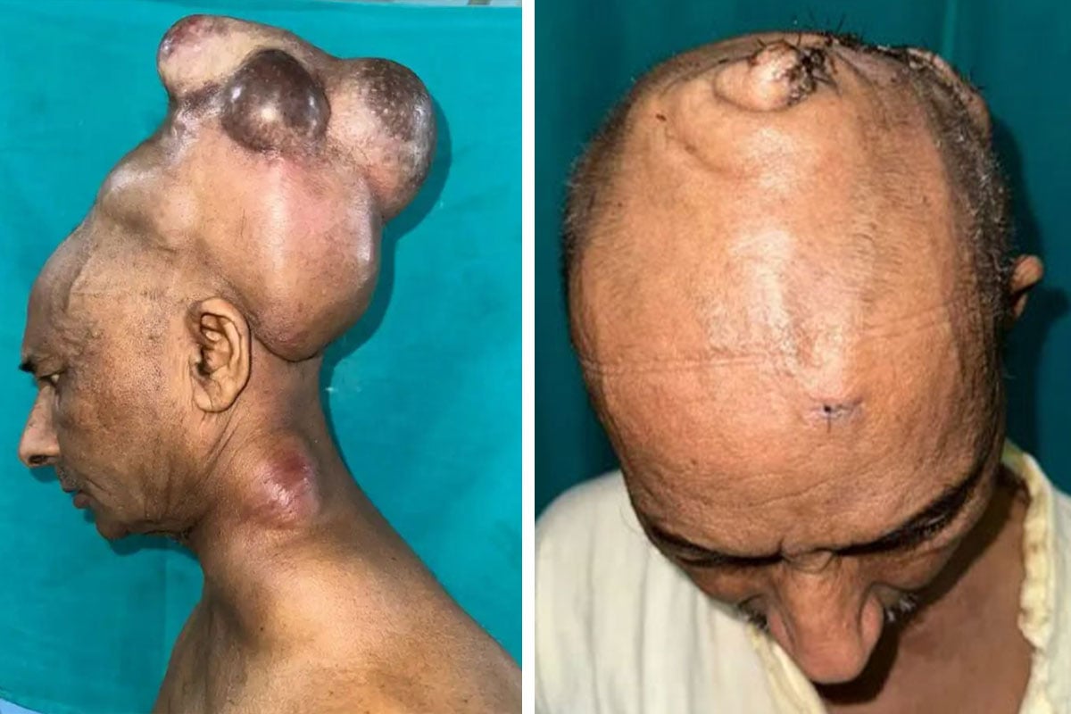 man-giant-head-tumor-removed-10-hour-operation-cover-800.jpeg