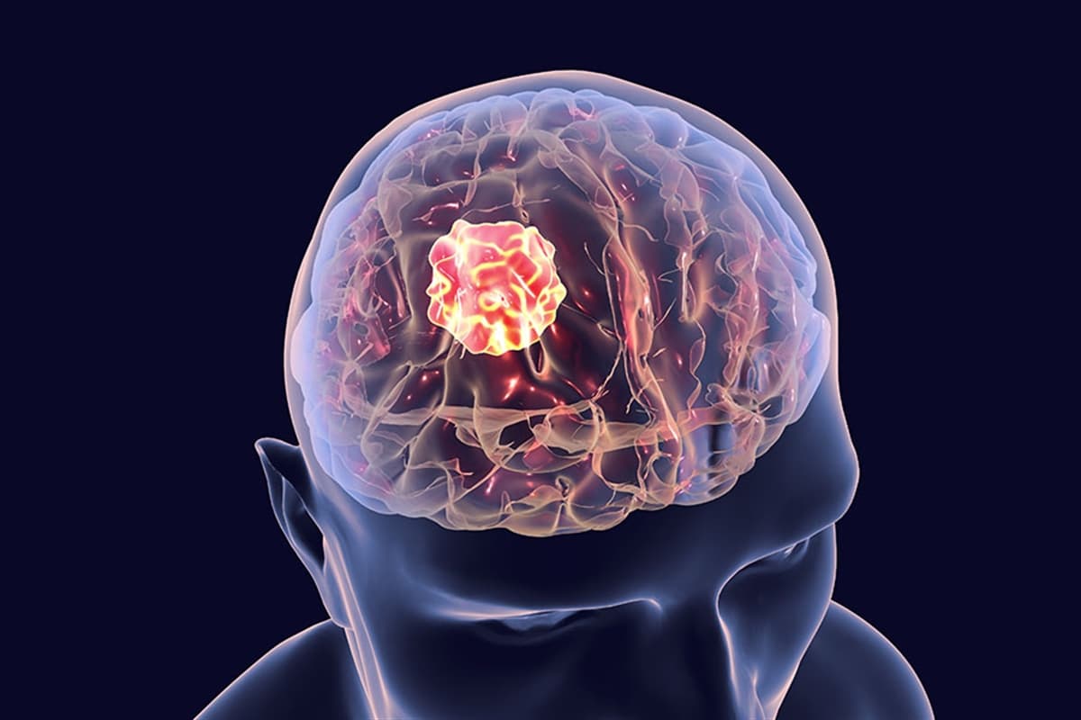 beyin-tumoru.jpg