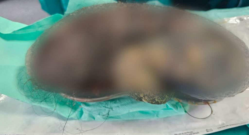 teen-went-to-hospital-with-tummy-ache-and-docs-found-8lb-hairball-in-stomach-2-1024x557.jpg