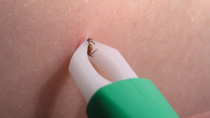 tick-removal.jpg