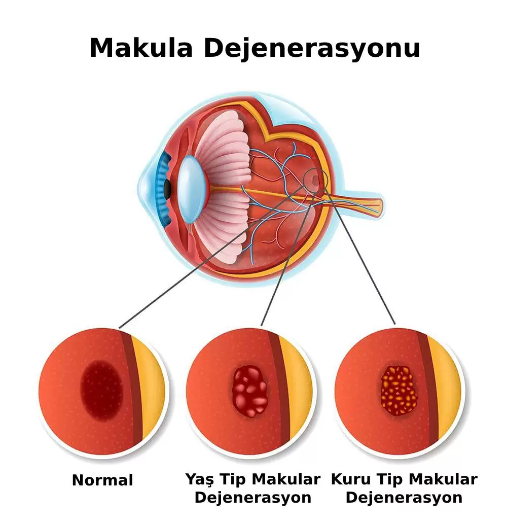 sari-nokta-hastaligi-2.webp