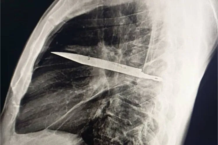 chest-xray-knife-081825-d7242324207a4a49bd71b30f425f87b5.webp