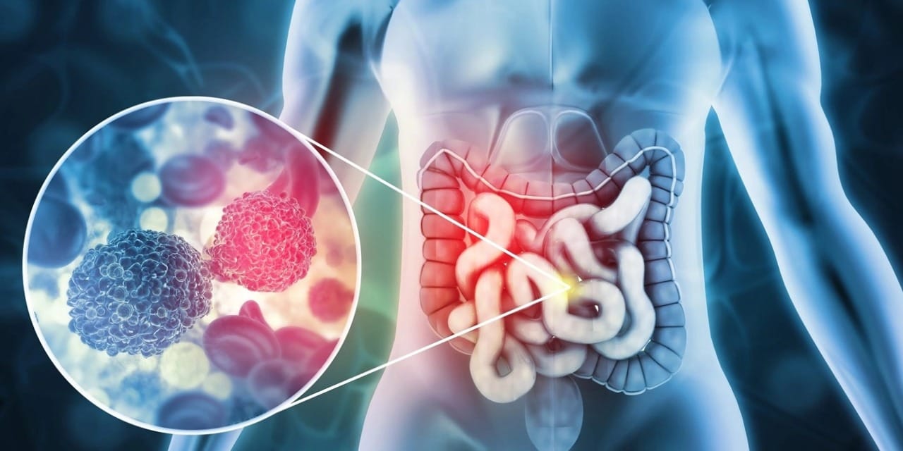 kolon-kanseri.jpg